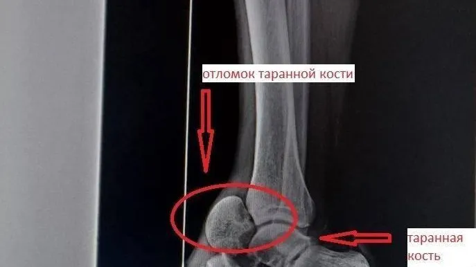 В Подмосковье травматологи вылечили мужчину с редким переломом кости