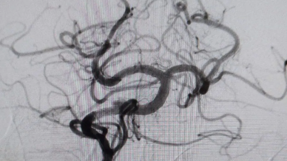 В Мытищах врачи спасли мужчину с редкой формой инсульта