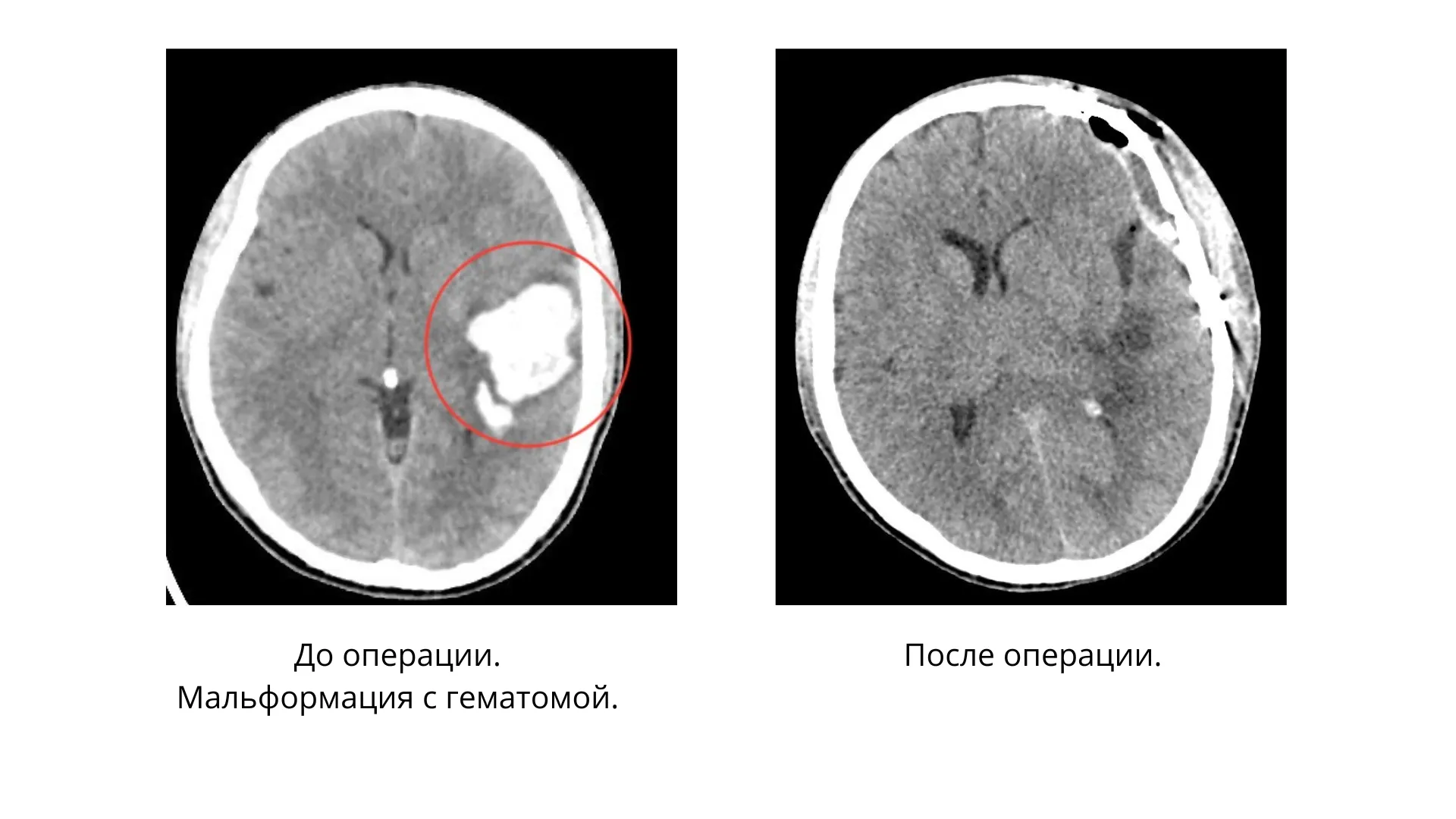 Врачи МОНИКИ удалили 18-летнему пациенту гематому в мозге