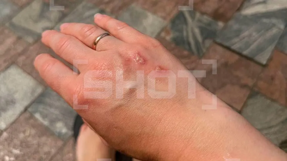 Волдыри и ожоги: ядовитые жуки атаковали россиян во Вьетнаме