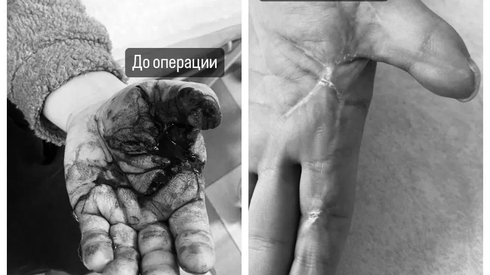 Травматологи Мытищ сохранили функцию кисти пациенту после взрыва петарды