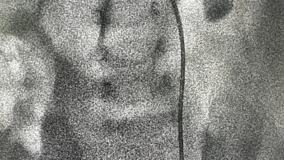 Врачи центра им Рошаля прооперировали 3-месячного ребенка с сужением мочеточника