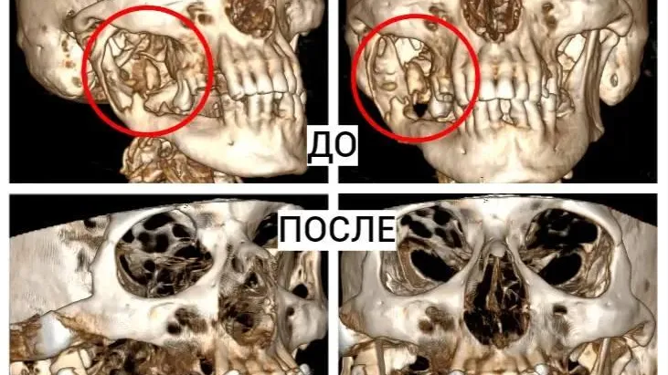 В Подмосковье врачи МОНИКИ восстановили пациенту нижнюю челюсть