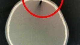 Врачи Центра им Рошаля извлекли дротик из черепа мальчика
