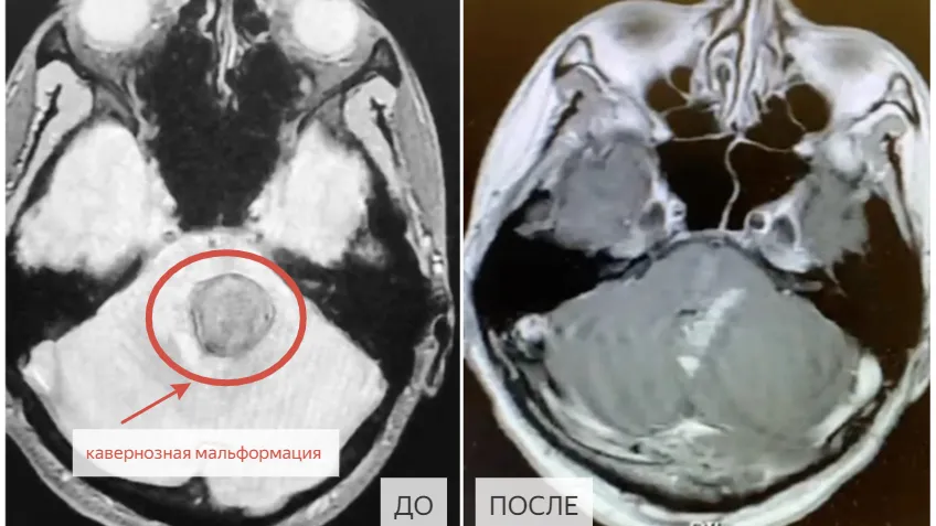 Нейрохирурги МОНИКИ удалили мужчине каверному ствола мозга