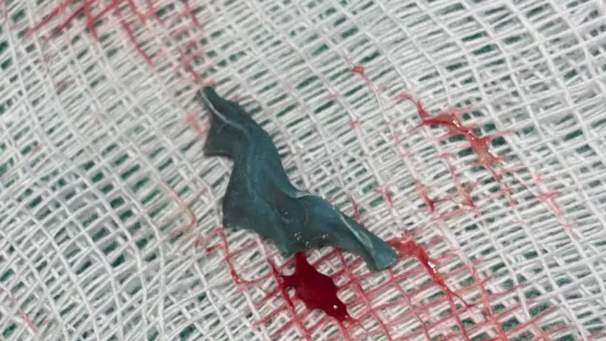 Видновские врачи извлекли инородное тело из пазухи носа пациентки