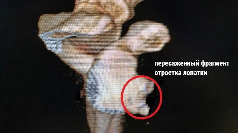 Реутовские врачи прооперировали мужчину, страдавшего от регулярных вывихов плеча