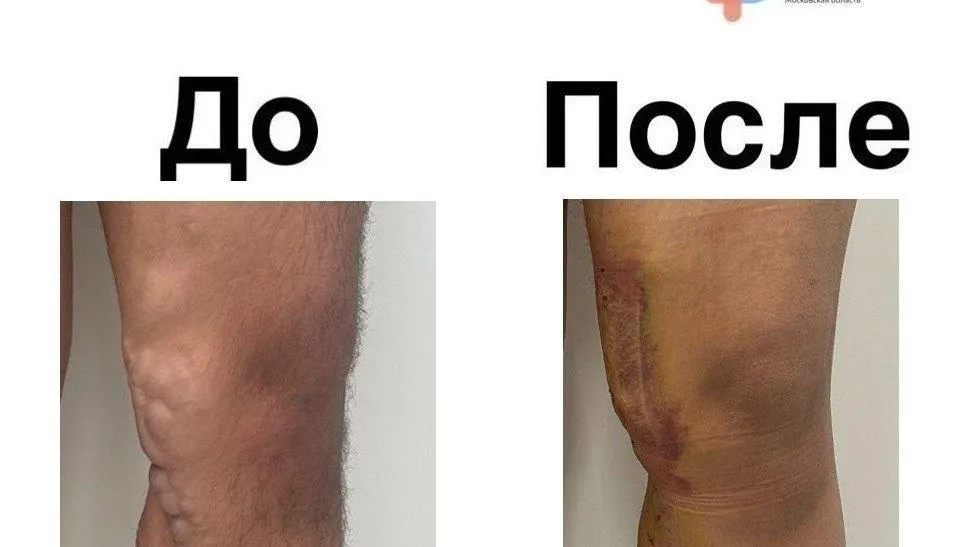 Хирурги центра Рошаля удалили венозные узлы у подростка