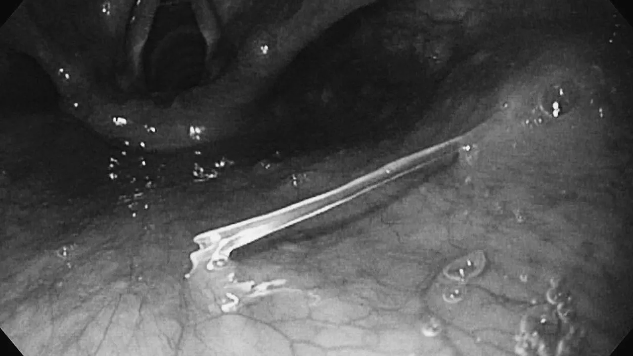 Врачи из Долгопрудного спасли женщину, проглотившую рыбью кость