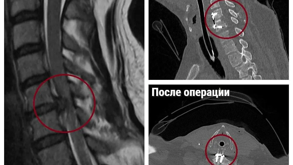 Нейрохирурги Коломны вернули подвижность мужчине после падения