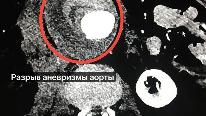 Врачи Подмосковья спасли мужчину с разрывом брюшной аорты
