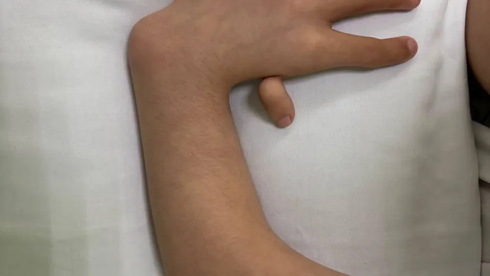 В Подмосковье врачи МОДКТОБ вылечили ребенка с косорукостью