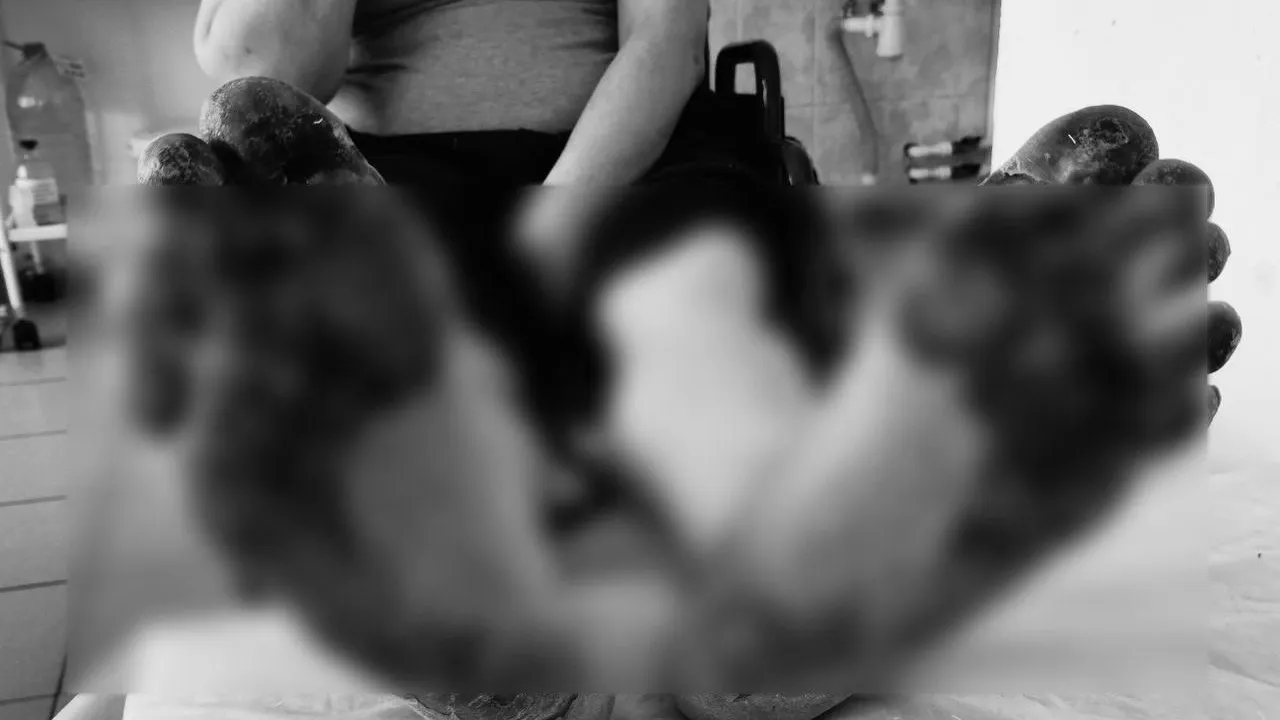 В Солнечногорске врачи спасли мужчину с ожогом стоп