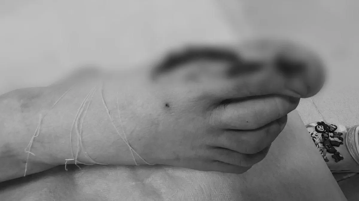 В Подмосковье врачи спасли подростка с травмой стопы