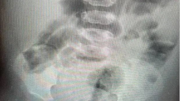 Хирурги центра Рошаля в Подмосковье удалили швейную иглу у годовалого мальчика