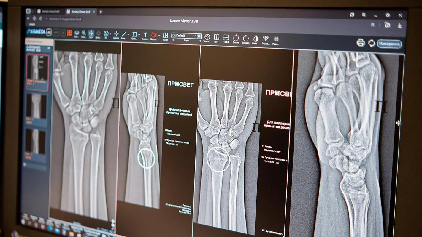 Две ИИ-системы для диагностики травм представили в Москве