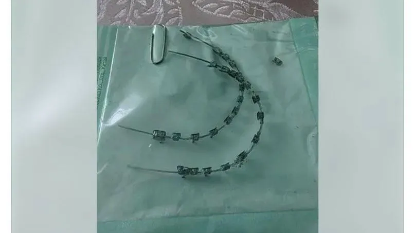 Есть желающие поносить? Россияне стали продавать использованные брекеты