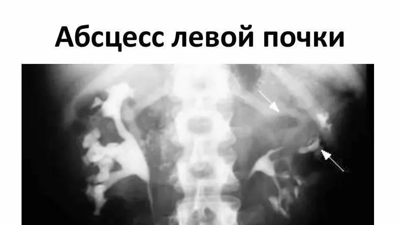 Врачи МОЦОМД успешно вылечили ребенка от абсцесса почки