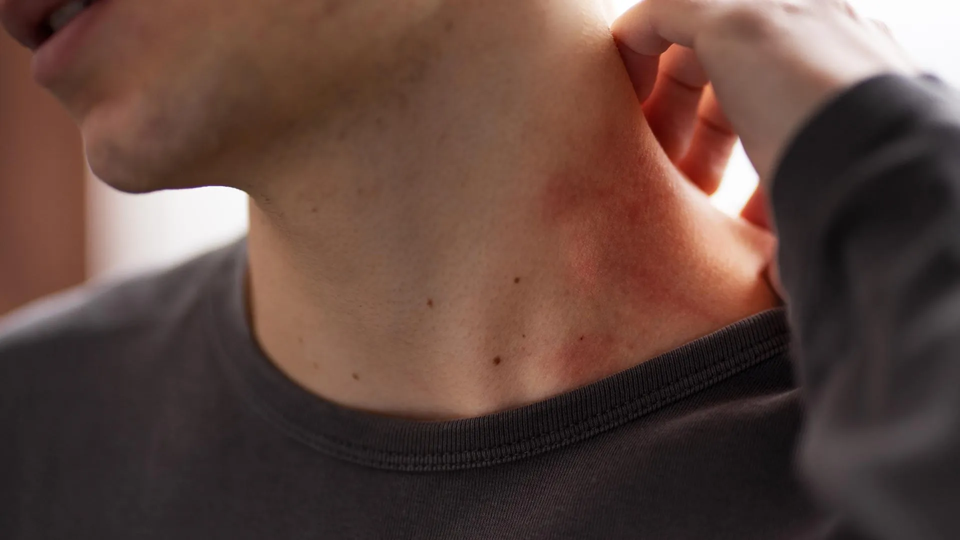 Врач развеяла миф о «сексуальной природе» оспы обезьян