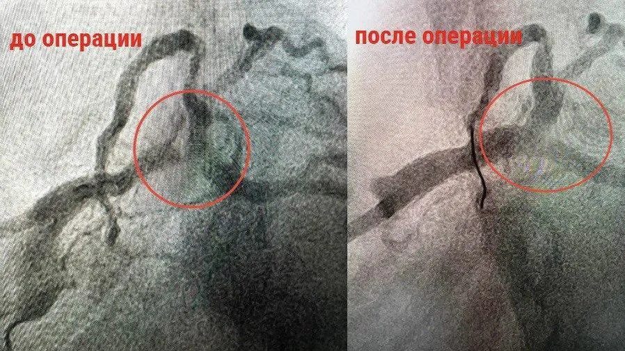 В Ступине провели сложнейшую операцию мужчине с тяжелым поражением артерии сердца