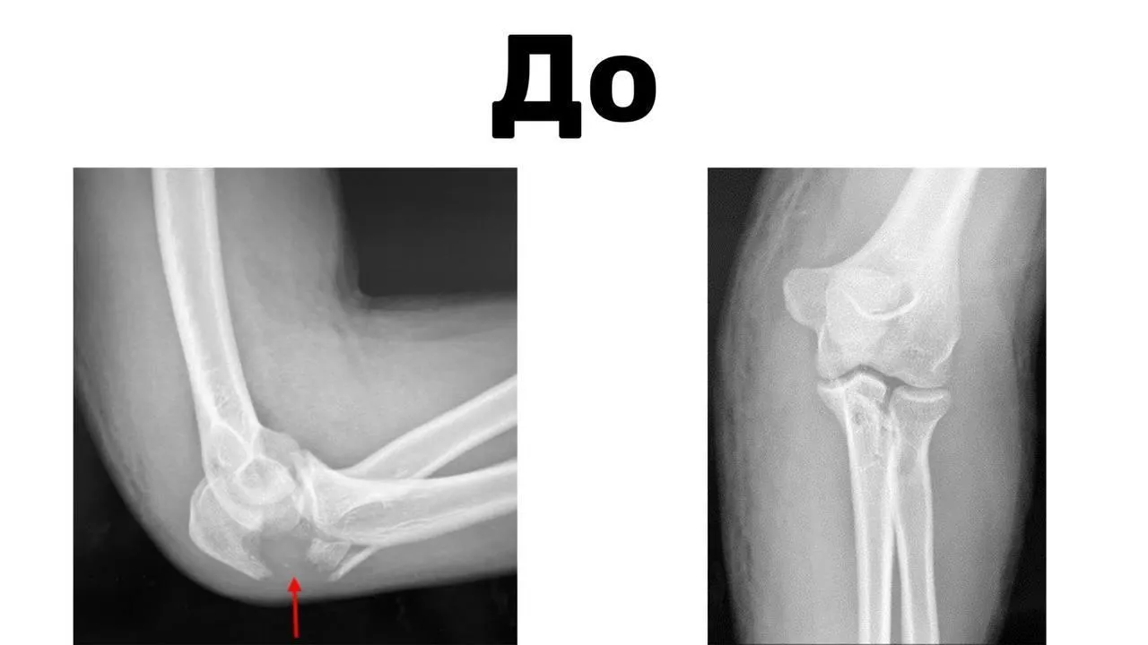 Врачи центра Рошаля прооперировали мальчика, сломавшего локоть на горнолыжном курорте