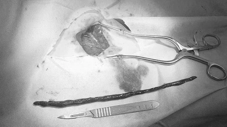 Врачи из Долгопрудного спасли жизнь пациентке с 21‑сантиметровым подвижным тромбом