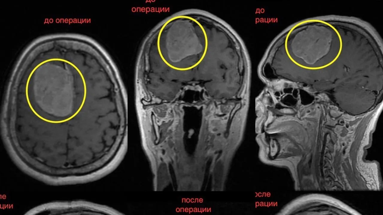 Врачи Одинцовского округа удалили женщине опухоль мозга размером с куриное яйцо
