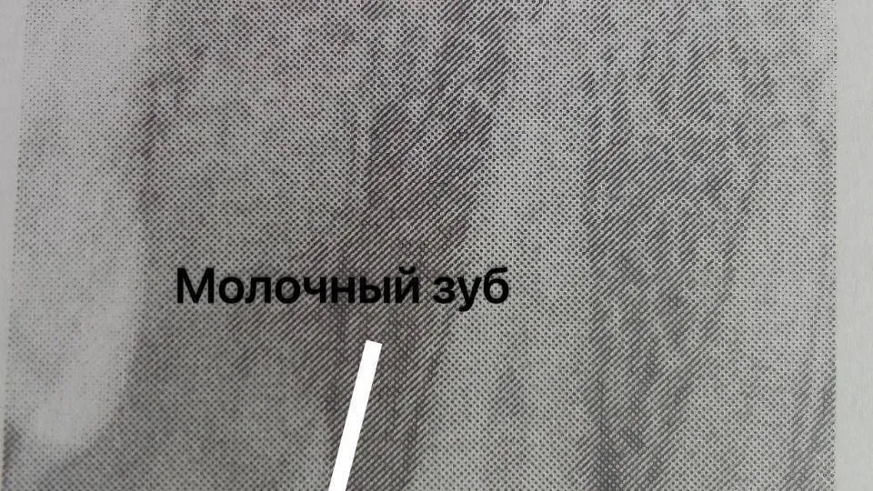 Стоматологи Подмосковья удалили 24‑летней девушке молочные зубы