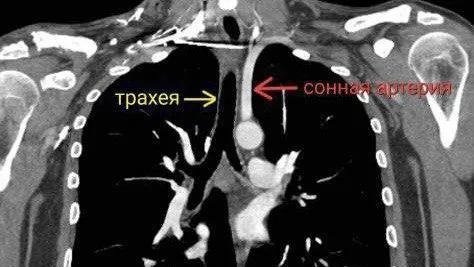 Врачи МОНИКИ удалили из грудной клетки мужчины 6‑сантиметровый отломок штифта