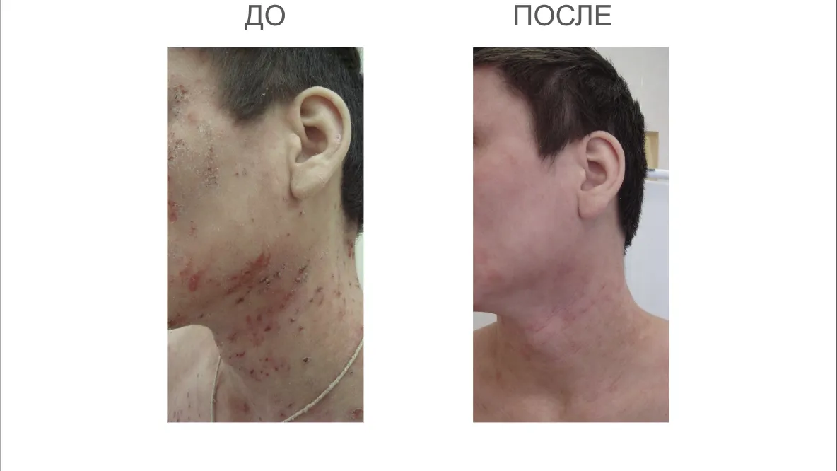 Врачи МОНИКИ Подмосковья помогли мужчине с тяжелой формой атопического дерматита