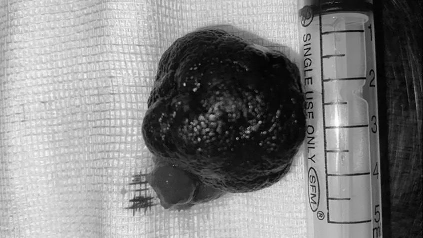 Врачи центра Рошаля в Подмосковье удалили подростку гигантский полип