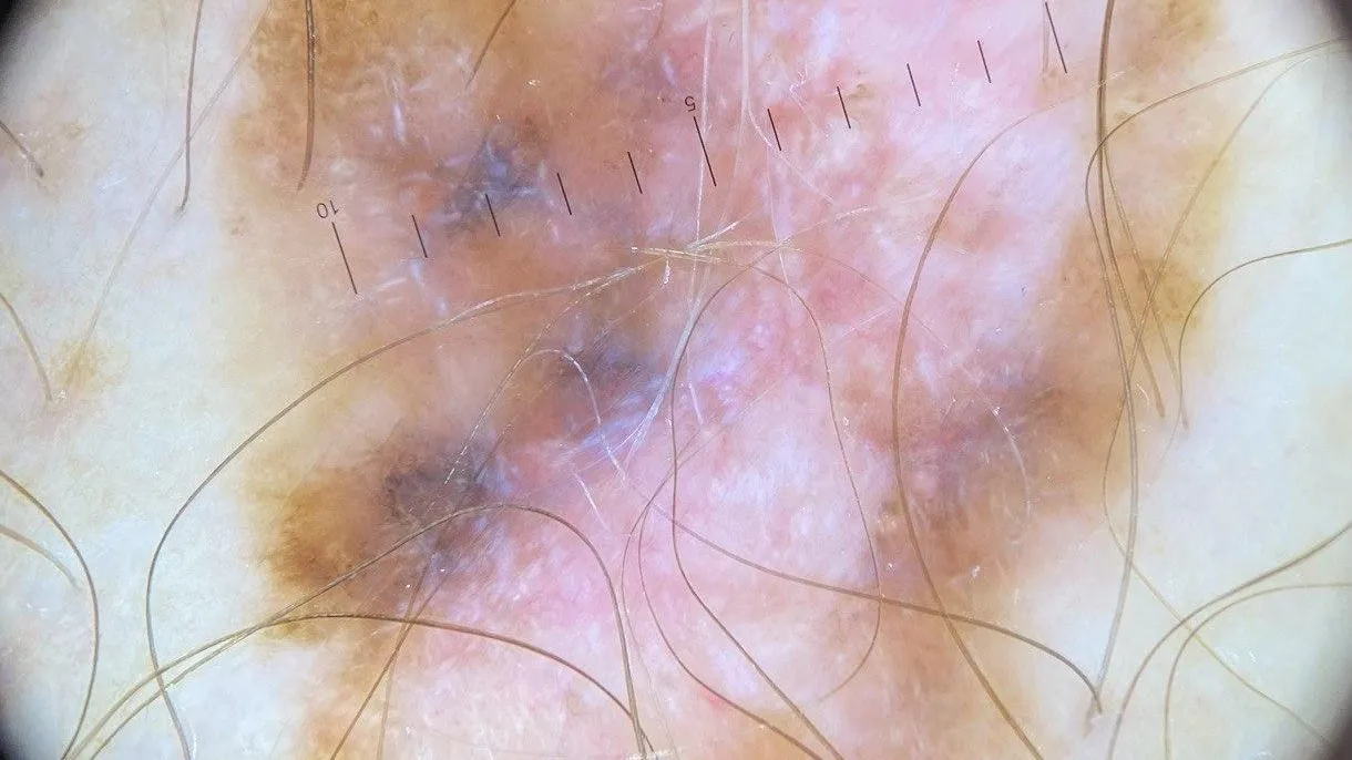 Врач из Подмосковья рассказал, какие родинки нужно удалять