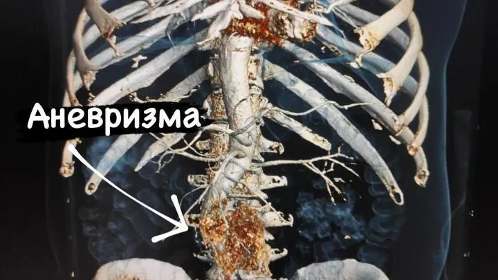Хирурги в Солнечногорске спасли мужчину с аневризмой