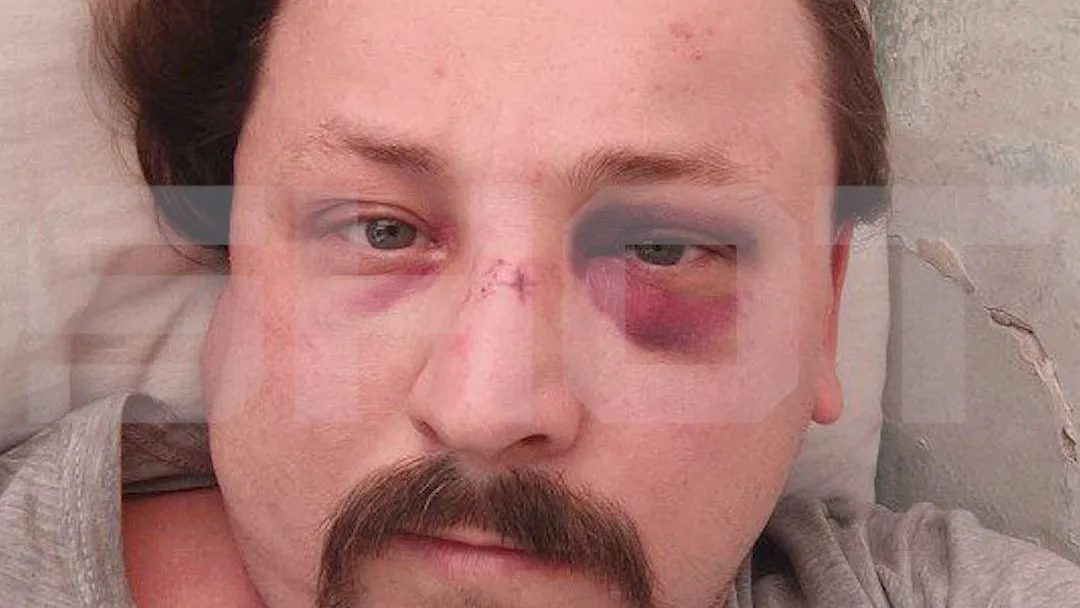 Ушиб мозга и кровоизлияние: глыба льда упала с 12 этажа на мужчину в Самаре