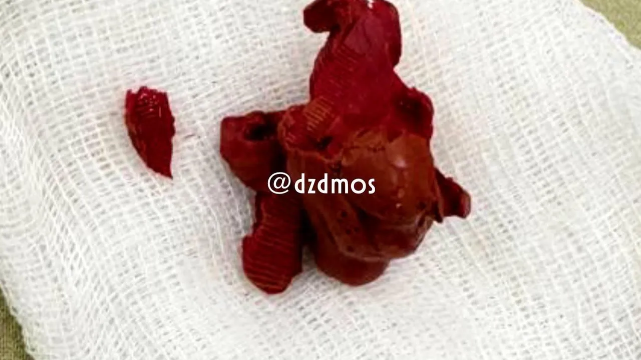 Размером с киви: пластилин достали из мочевого пузыря школьника