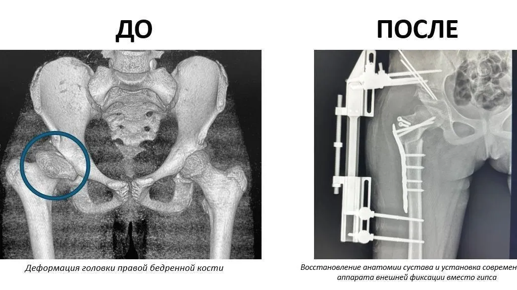 Врачи центра Рошаля спасли тазобедренный сустав юной спортсменке