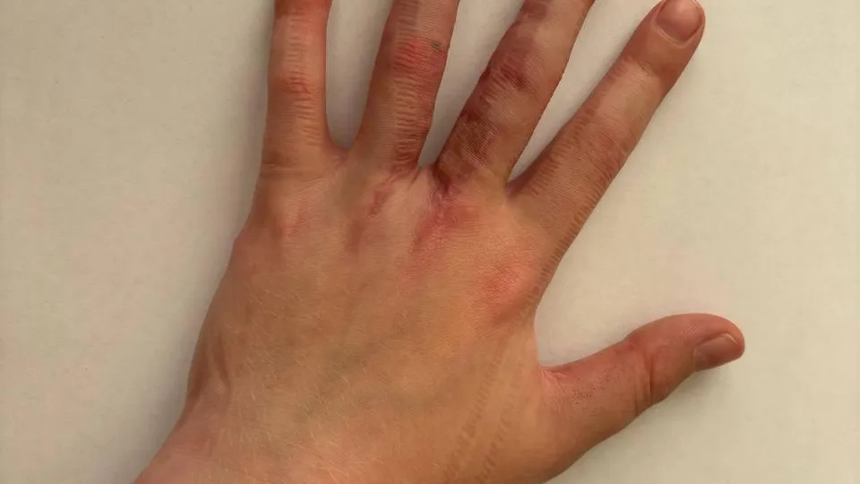 Специалисты МОДКТОБ демонстрируют высокие результаты лечения синдактилии