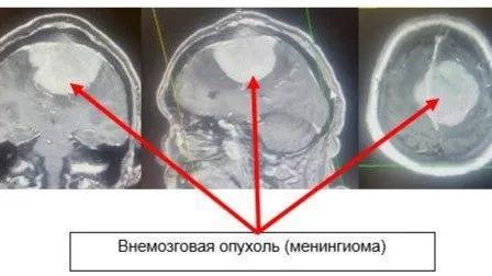 Нейрохирурги Подмосковья спасли пациентку с опухолью головного мозга