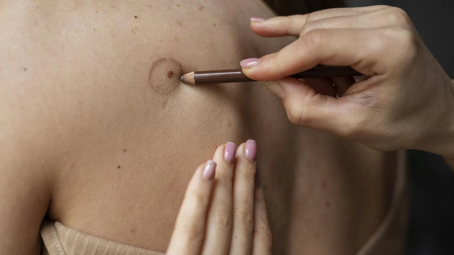 Врач назвала признаки опасной родинки и дала советы по профилактике меланомы