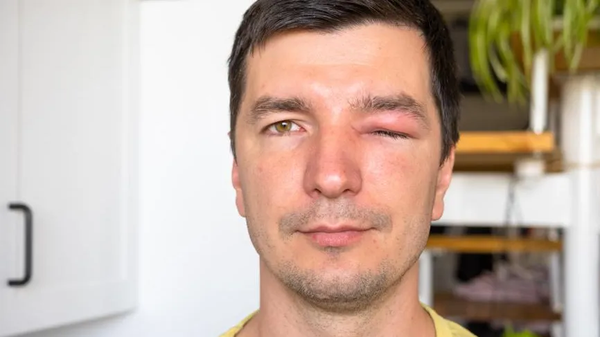 Аллерголог назвала симптомы при укусе пчелы, которые требуют срочной медпомощи
