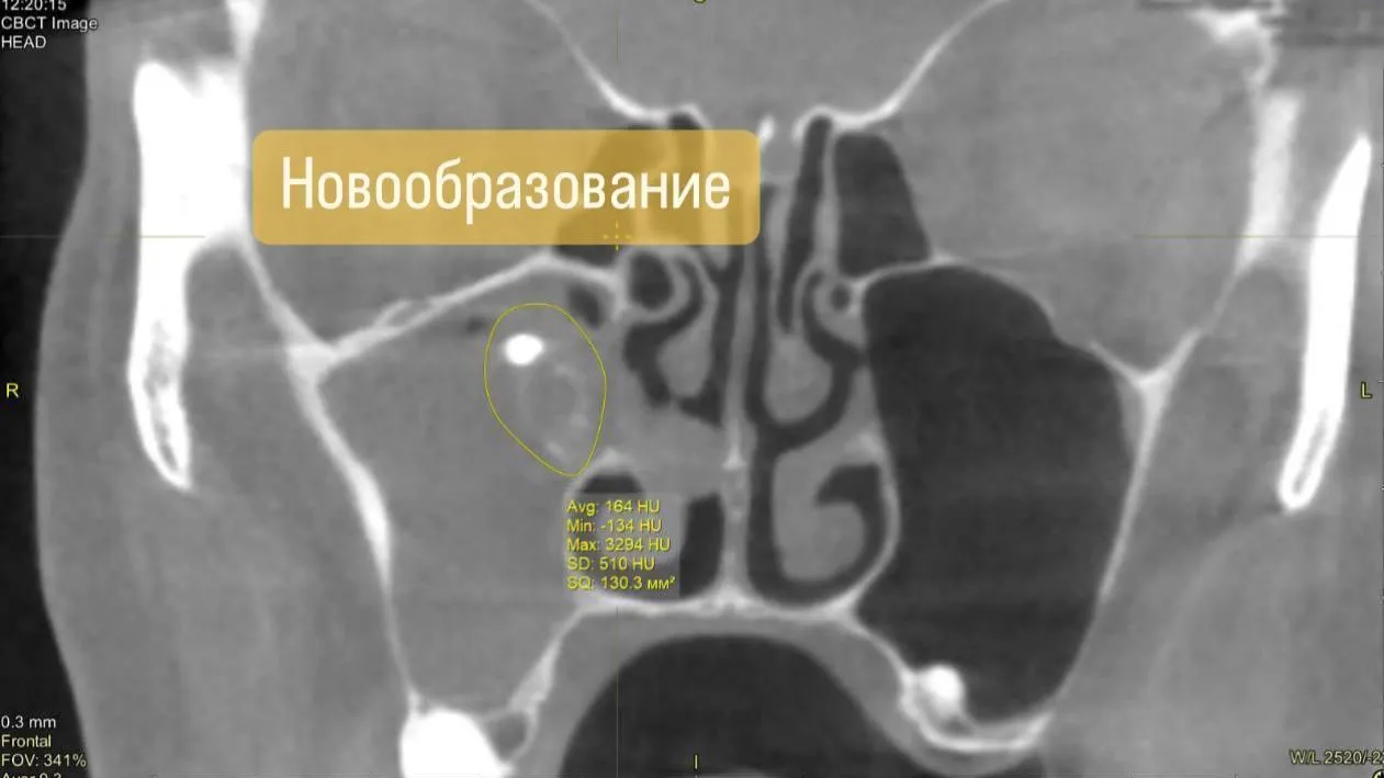 Врачи Ступина помогли 64‑летней пациентке избавиться от постоянной заложенности носа